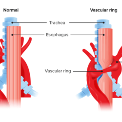 Division of vascular ring with reanastomosis cpt code