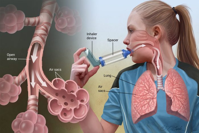 Asthma attack ems disease patient symptoms steps end start prolonged there tract respiratory